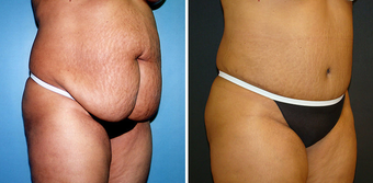 Tummy Tuck (Abdominoplasty) with Liposuction after 262729