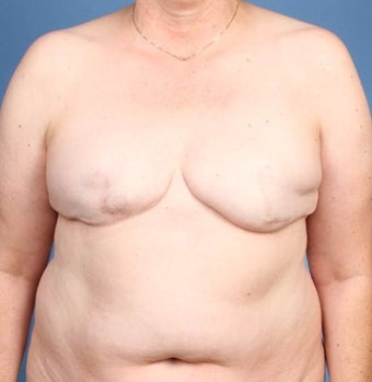 Breast Reconstruction before 539979
