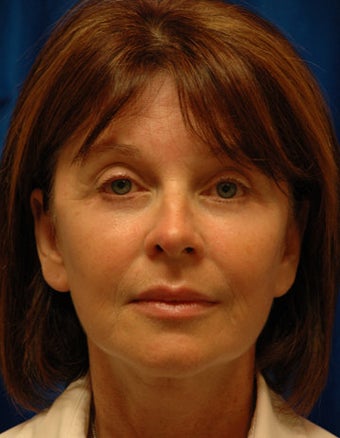 Facelift, Forehead and Eyelid Lift Surgery after 121719