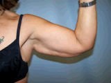 Arm Lift 356563