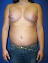 Constricted Breast Deformity after 136215