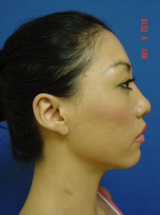 Chin Augmentation/rhinoplasty 383867