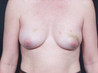 46 Year Old Female for Breast Reconstruction before 643179