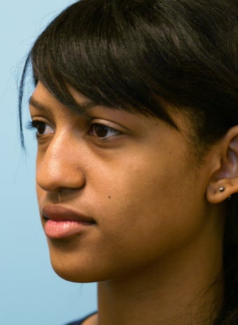 Nose Reshaping before 574628