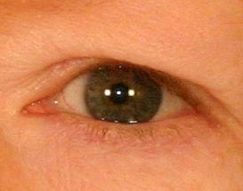 Upper Blepharoplasty (Upper Eyelids) 376859