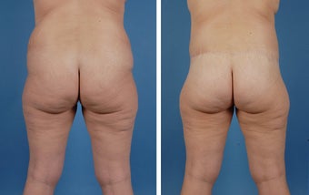 Lower Body Lift and Liposuction of Lateral Thighs after 303681