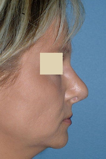 Revision Rhinoplasty before 88144