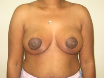 Mastopexy, breast lift after 365124