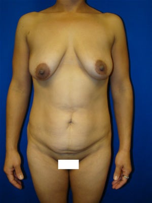 Tummy tuck, Breast Lift, Breast Augmentation before 91038