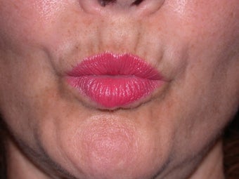 Before and After Botox to Upper Lip Lines before 53817