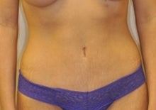 Abdominoplasty with Lipoabdominoplasty technique after 247247