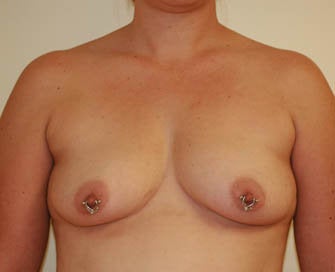 Augmentation Mammaplasty (Breast Implants) before 226487