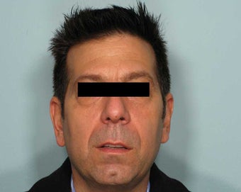 The Liquid Facelift for a Man before 349802