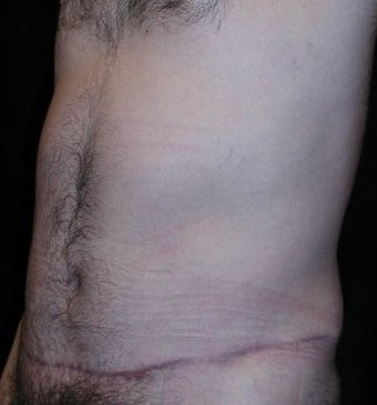 Male tummy Tuck 578190
