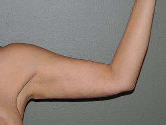 Arm Lift after 530722
