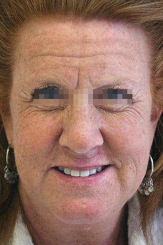 Botox for Forehead, Glabella and Crows Feet before 114165