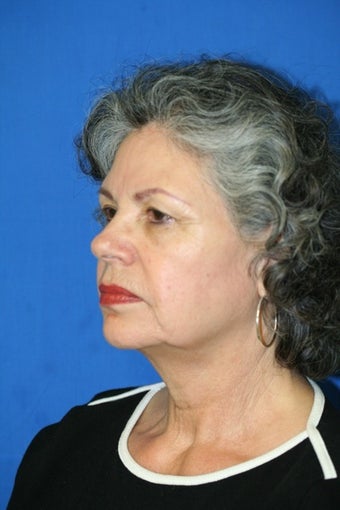 Facelift before 138675