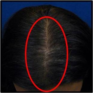 Female Hair Restoration 530044