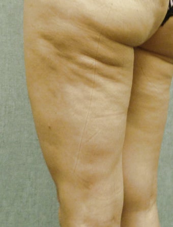 Cellulaze 571582