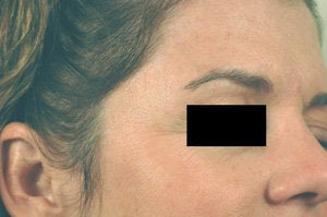 Crow's feet treatment before 88219