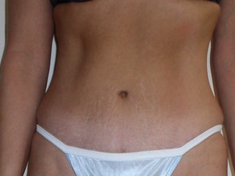 Mini Abdominoplasty after 374416