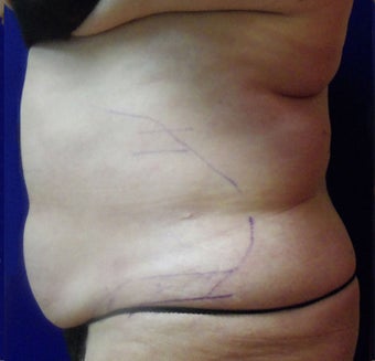 VASER Shape to Abdomen after 433051