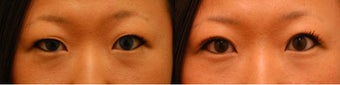 Asian Blepharoplasty ("Double Eyelid" Procedure) before 136812