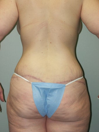 Belt Lipectomy and Breast Lift 379775
