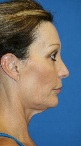 Facelift with Extended Necklift and Upper Blepharoplasty 641627