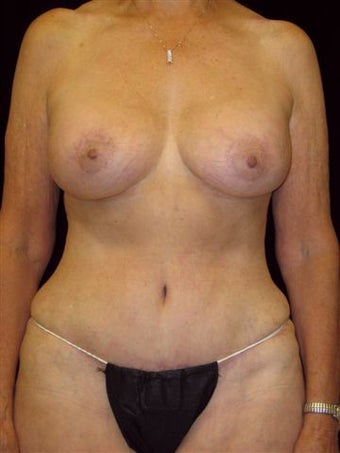 Mommy Makeover after 504767