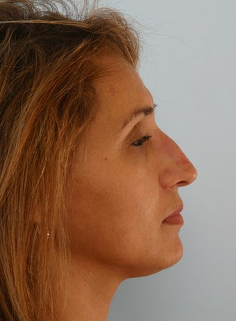 Non Surgical Rhinoplasty Juvederm Ultra Plus before 260324