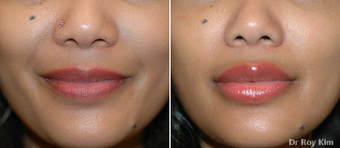 Fat transfer to upper and lower lips before 277749