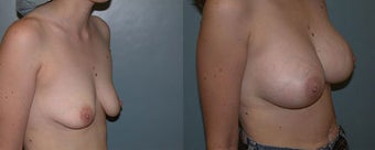 Breast Augmentation (A cup to C cup) before 96471
