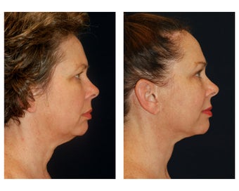 Facial Rejuvenation 374118