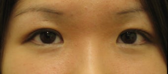 Double eyelid surgery by CO2 laser after 259535