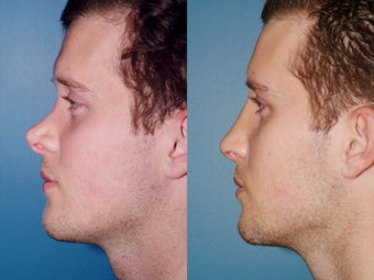 Revision rhinoplasty after 334244
