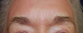 Total FX CO2 Laser after 564751