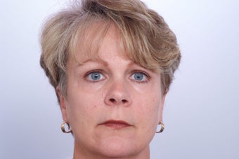 Endoscopic Brow Lift after 250438