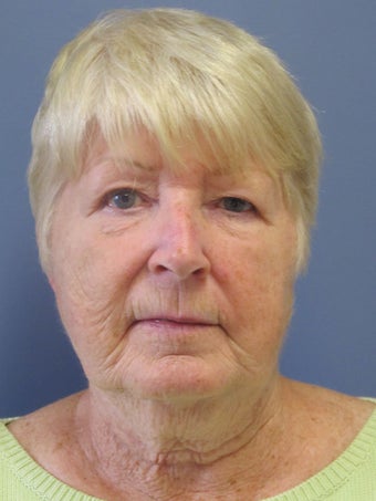 Neck Lift, Platysmaplasty before 634731