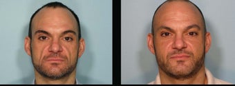 Sculptra before 460588