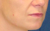Lift Lip 635458