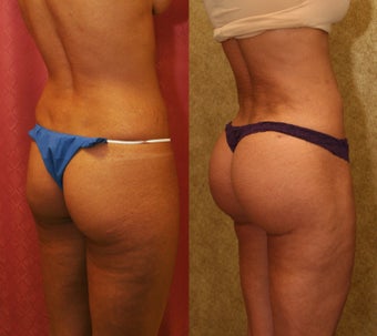 Brazilian buttock augmentation with fat grafting to the buttocks with liposuction in Los Angeles before 583430