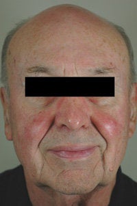 Pulsed Dye Laser Treatment for Rosacea before 104186