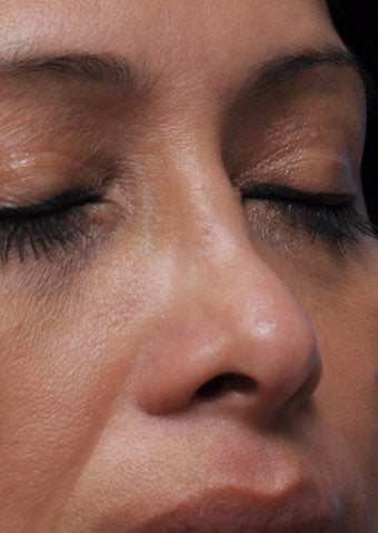 Non-Surgical Nose Job before 430195