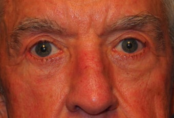Extended lower lid blepharoplasty after 480035