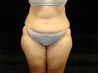 Extended Abdominoplasty before 203401