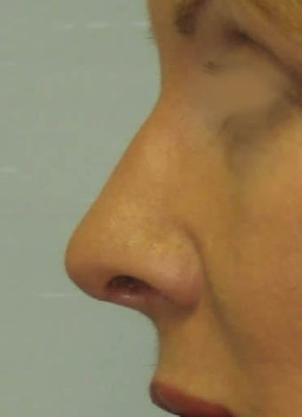 Revision Rhinoplasty 410624