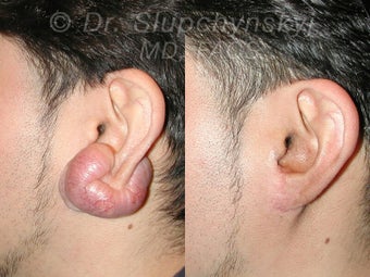 Keloid Removal 551920