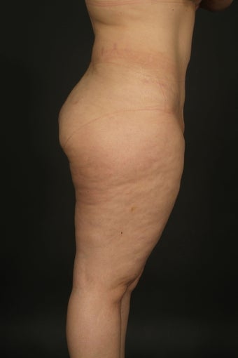 Abdominoplasty and Liposuction "Mommy Makeover" after 132413