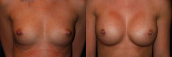 Breast Augmentation before 382853
